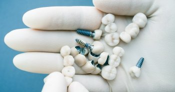 Jak długo wytrzymują implanty i co zrobić, aby służyły przez całe życie?