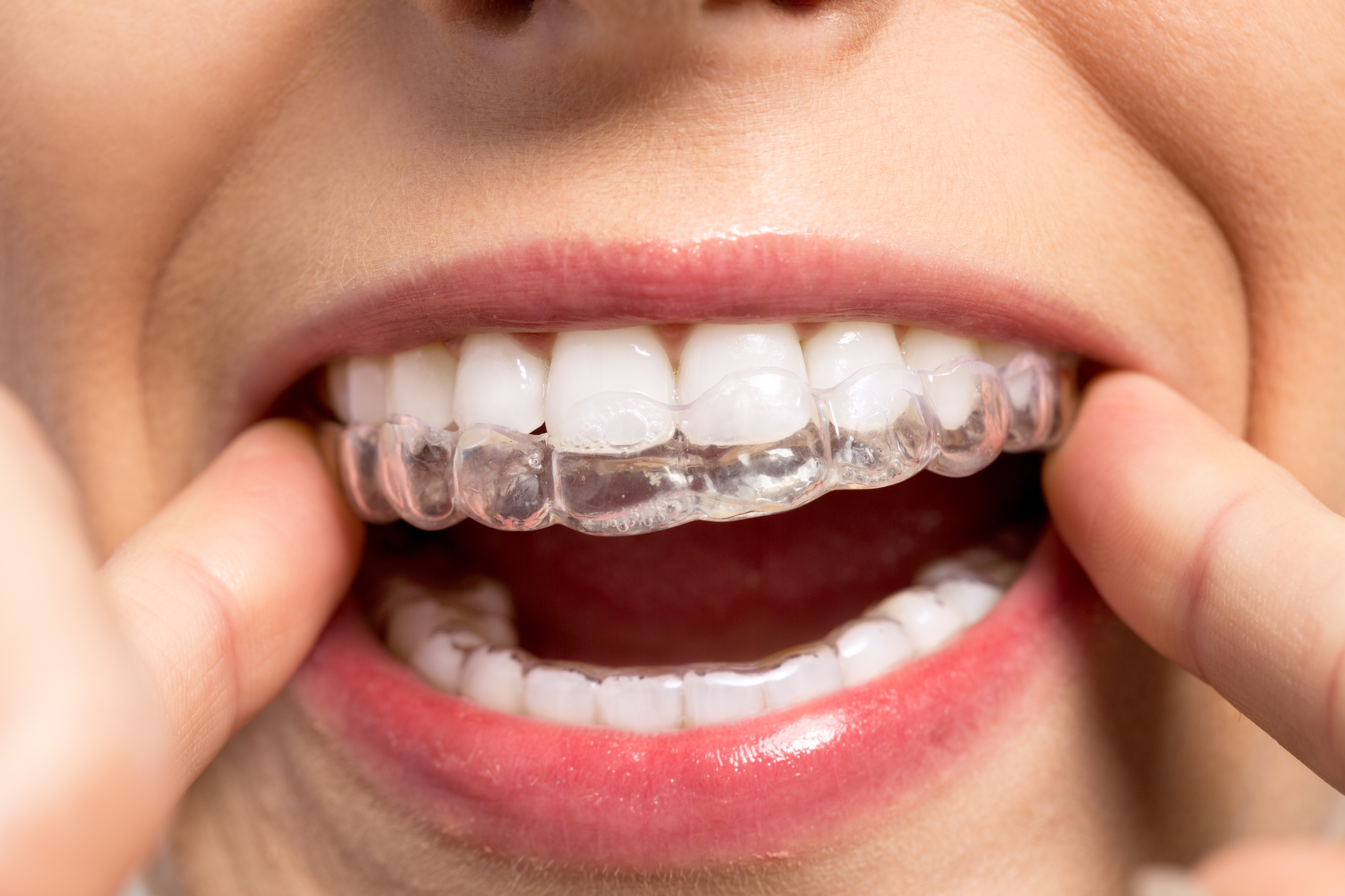 Anna Dental Clinic Offer 01 01 01