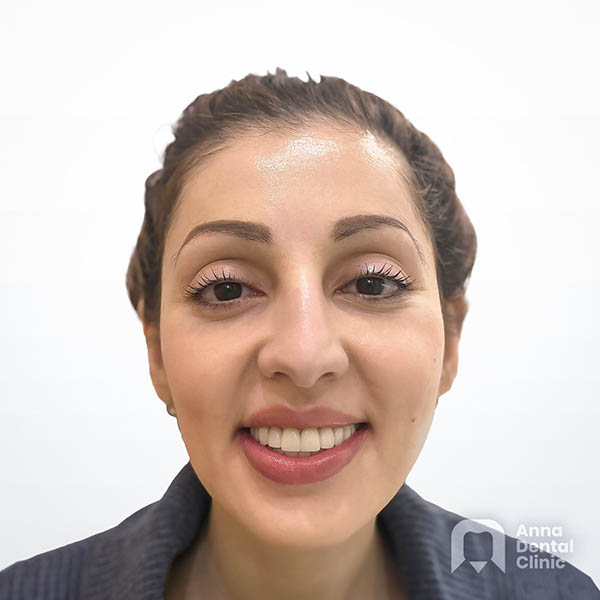 Smile Makeover | Emila