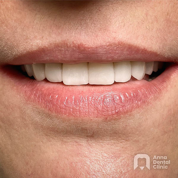 Smile Makeover | Bożena