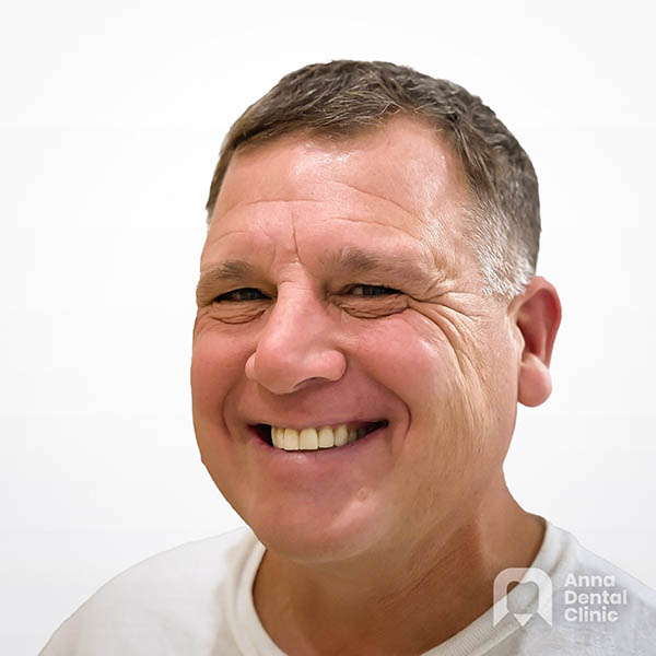 Smile Makeover | James