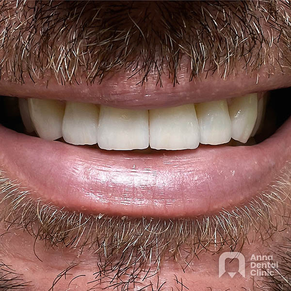 Smile Makeover | Ryszard