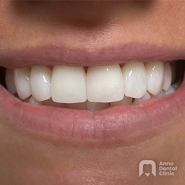 Smile Makeover | Melina