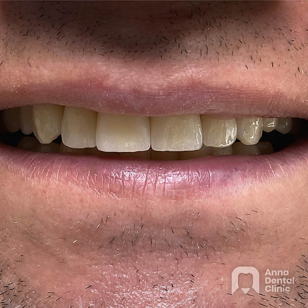 Smile Makeover | Adrian