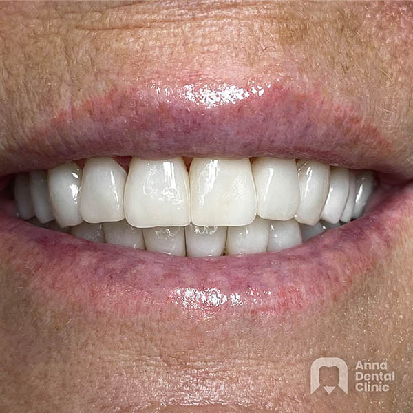 Smile Makeover | Kristina