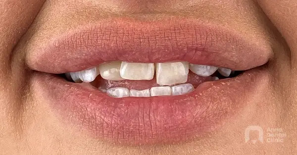 Metamorfoza uśmiechu