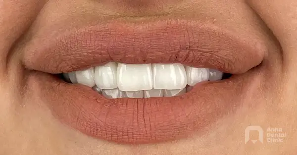 Metamorfoza uśmiechu