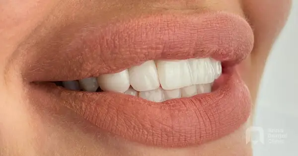 Metamorfoza uśmiechu