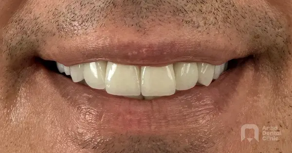 Metamorfoza uśmiechu