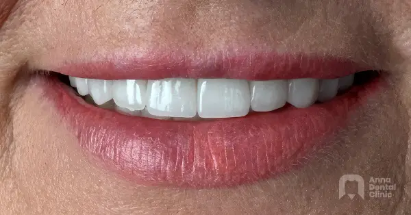 Metamorfoza uśmiechu