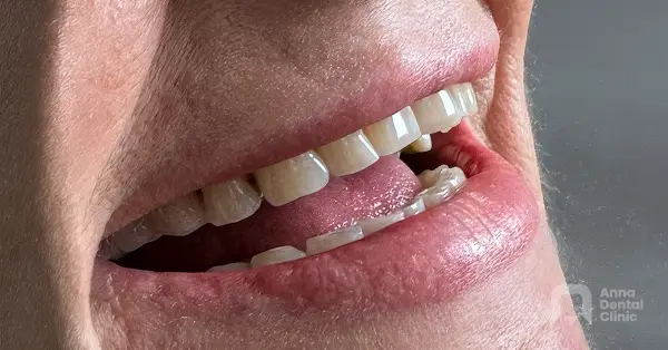 Metamorfoza uśmiechu