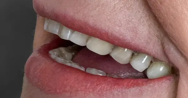 Metamorfoza uśmiechu