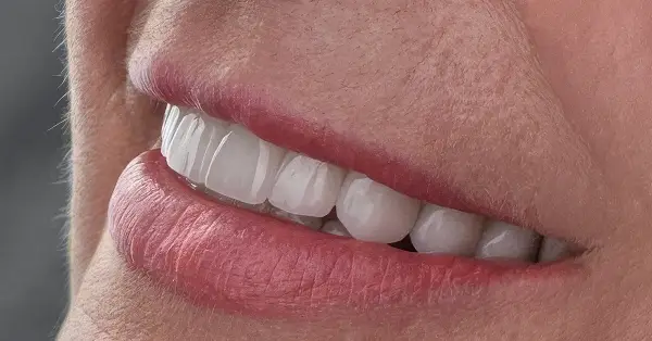 Metamorfoza uśmiechu