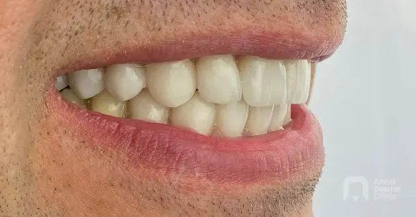 Metamorfoza uśmiechu