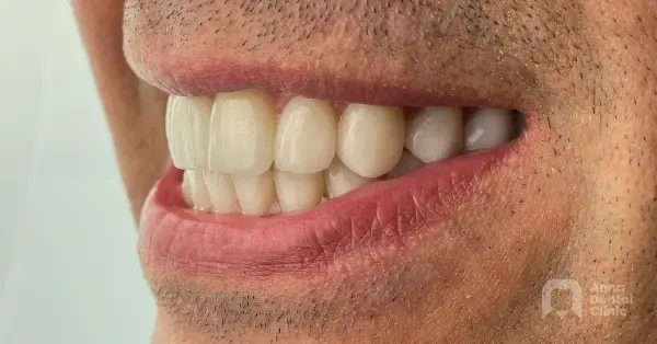 Metamorfoza uśmiechu