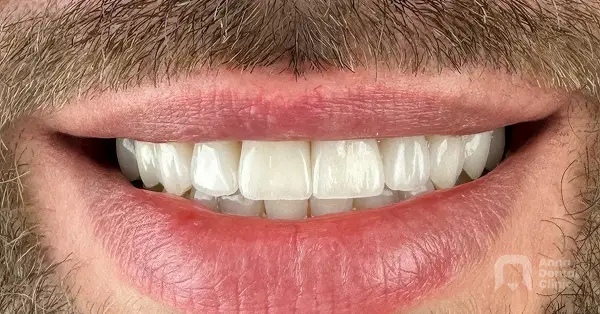 Metamorfoza uśmiechu