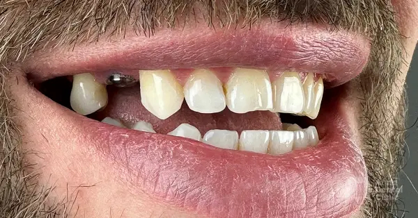 Metamorfoza uśmiechu