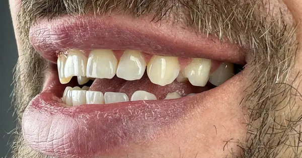 Metamorfoza uśmiechu