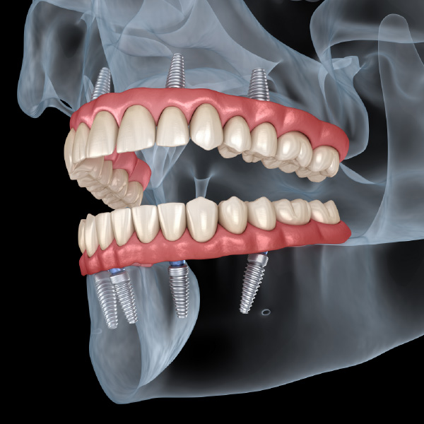 Implanty stomatologiczne